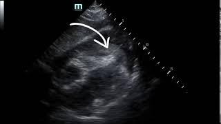 Pericardial clot  US, annotated  JETem 2019