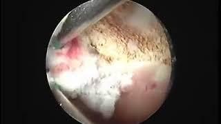 Hystroscopic metroplasty by Dr/ waleed almery