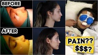 NOSE JOB CHECK: COST, RECOVERY, PAIN (before & after)