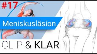 Meniskusläsion erklärt - Schmerz, Schwellung, Gelenkblockade