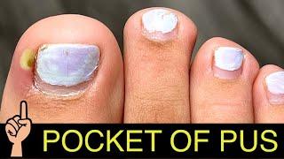 INFECTED INGROWN TOENAIL SURGERY