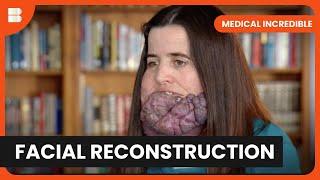 Meet the man with super-stretchy skin! - Medical Incredible - Documentary