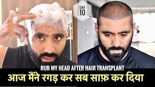 Day 10: Today I have cleaned my hair by rubbing it |Easy way to clean hair |Hair Transplant Journey