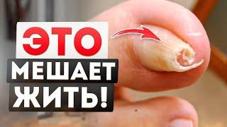 КАК ИЗБАВИТЬСЯ ОТ СКРУЧЕННОГО НОГТЯ! Причина БОЛИ в Ногах! (Простые Советы От Подолога)