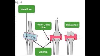 Phenotypic Alignment in TKA