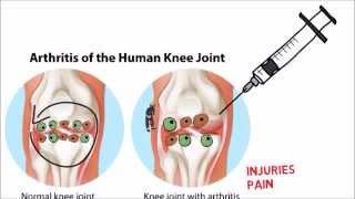 What is stem cell therapy (Orthobiologics)