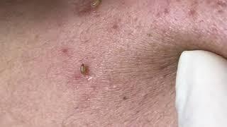 BIG BLACKHEADS / ACNE TREATMENT WITH VU QUYNH MI SPA PIMPLE POPPING 2023 #002