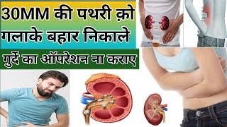 30MM तक की पथरी को गला के बाहर निकले #trending #healthtips#youtube #viralvideo