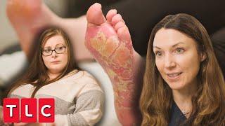 Debilitating Inflammatory Skin Disorder: Dr. Emma Treats Palmoplantar Pustulosis | Save My Skin