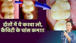 teeth seal process | teeth sealants procedure