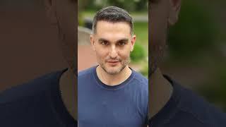 Transformative Hair Transplant Results: A Journey to Full, Natural Hair Restoration!