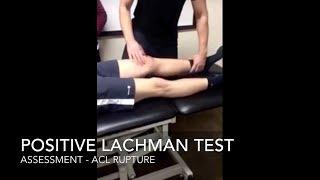 Positive Lachman test