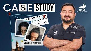 Women Hair Transplant Case Study | 3200 Grafts | Dr. Firdavs Ahmedov | Smile Hair Clinic