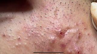 Relaxing Satifying About Blackheads& Whiteheads Removal