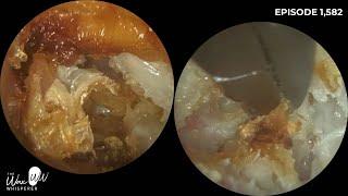 1,582 - Ear Wax Removal, Dead Skin & Debris Extraction from Mastoidectomy Ear