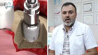 Dental İmplantların Başarısı İçin Kemik Yapısının Önemi - Dr. Serhan Aktan