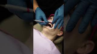 Insight into Designing Veneers