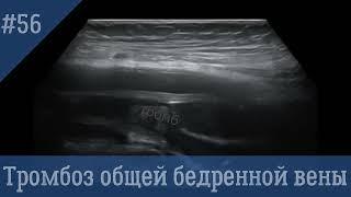 УЗИ сосудов. Тромбоз общей бедренной вены.