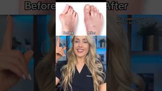 Doctor explains how to correct bunions #LapiplastyPartner