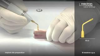 PIEZOSURGERY - HANDS-ON - Implant site preparation