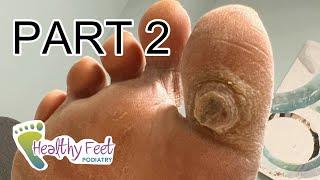 DEEP SATISFYING CALLUS TREATMENT - PART 2