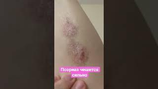 #psoriasis #псориаз Сильно чешется псориаз что делать