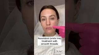 Smile line treatment with smooth threads #antiaging #antiwrinkle #threadlift #smooththreads #nacmd