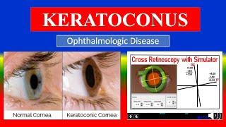 KERATOCONUS - Definition, types, causes, pathophysiology, symptoms , diagnoses , medicine