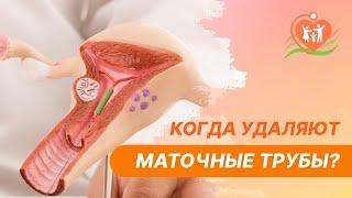  Когда удаляют маточные трубы?