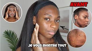 SKINCARE ROUTINE SIMPLE CONTRE LES BOUTONS ET LES TÂCHES  | ACNE SKINCARE ROUTINE