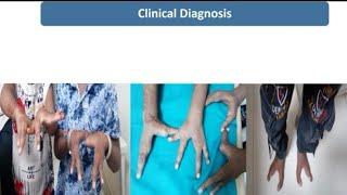 Split Hand and Foot Syndrome (SHFS) or Lobster Hands || Spot Diagnosis - 3 || Pediatrics