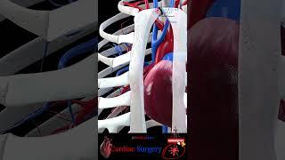 Open Heart  Cardiac Surgery ╭️～ Heart Bypass || 3D Medical Animation