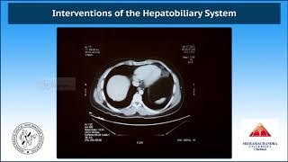 Interventions of the Hepatobiliary System