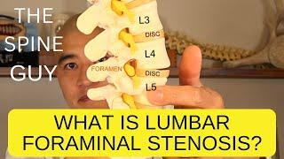 What is Lumbar Foraminal Stenosis?