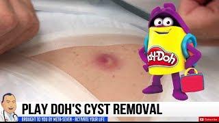 Play Doh Cyst | Dr. John Gilmore's New Bump