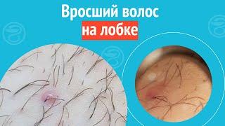  Вросший волос на лобке. Клинический случай №1364