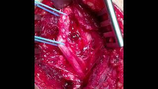 Future of Nerve Surgery