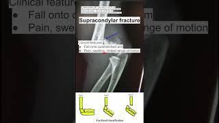 Supracondylar fracture