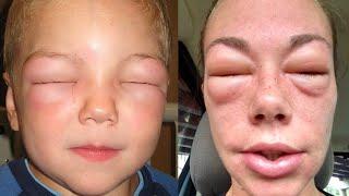 ازاي تنقذ شخص اصيب بحساسية من الادوية او الاطعمة او لدغة الحشرات_  first aid in allergy