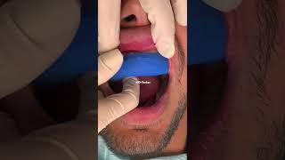 Porcelain veneers process | porcelain veneers procedure | Dr. Yazdan | smile makeover #veneers