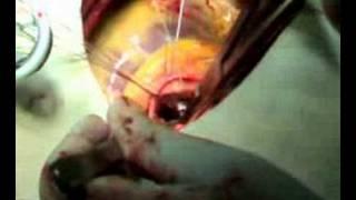 Aortic valve replacement