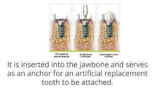 Advantages & Disadvantages of Dental Implants