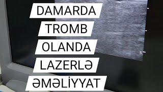 tromb tromblasma quyruqlu tromblar flotasiya tromboflebit varikoz damar xesteliyi sigorta ablasiya