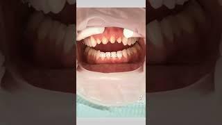 Porcelain crowns procedure | porcelain veneers how we do it | Dr. Yazdan