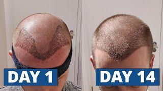 1 - 14 Days After Hair Transplant: The Complete Healing Process