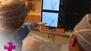 Interventional Neuroradiology - Mercy Neurological Institute