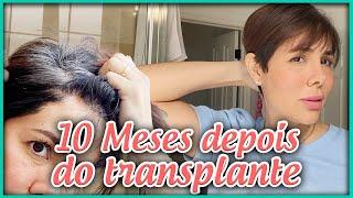 10 MESES DE TRANSPLANTE CAPILAR | DICAS | ARREPENDIMENTO | INFORMAÇÃO