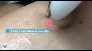 Laser Vein Removal Treatment for the Face and Body