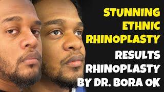 Stunning Ethnic Rhinoplasty Results | Rhinoplasty by Dr. Bora Ok