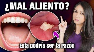 BAD BREATH? It may be due to TONSIL STONES l What causes them and how to eliminate them?‍️